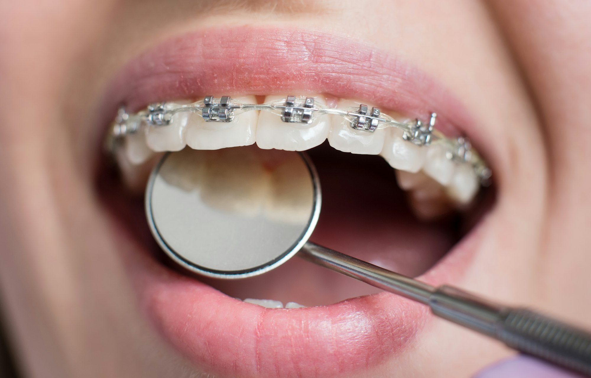 Macro shot of white teeth with braces. Female patient with metal brackets at the dental office.