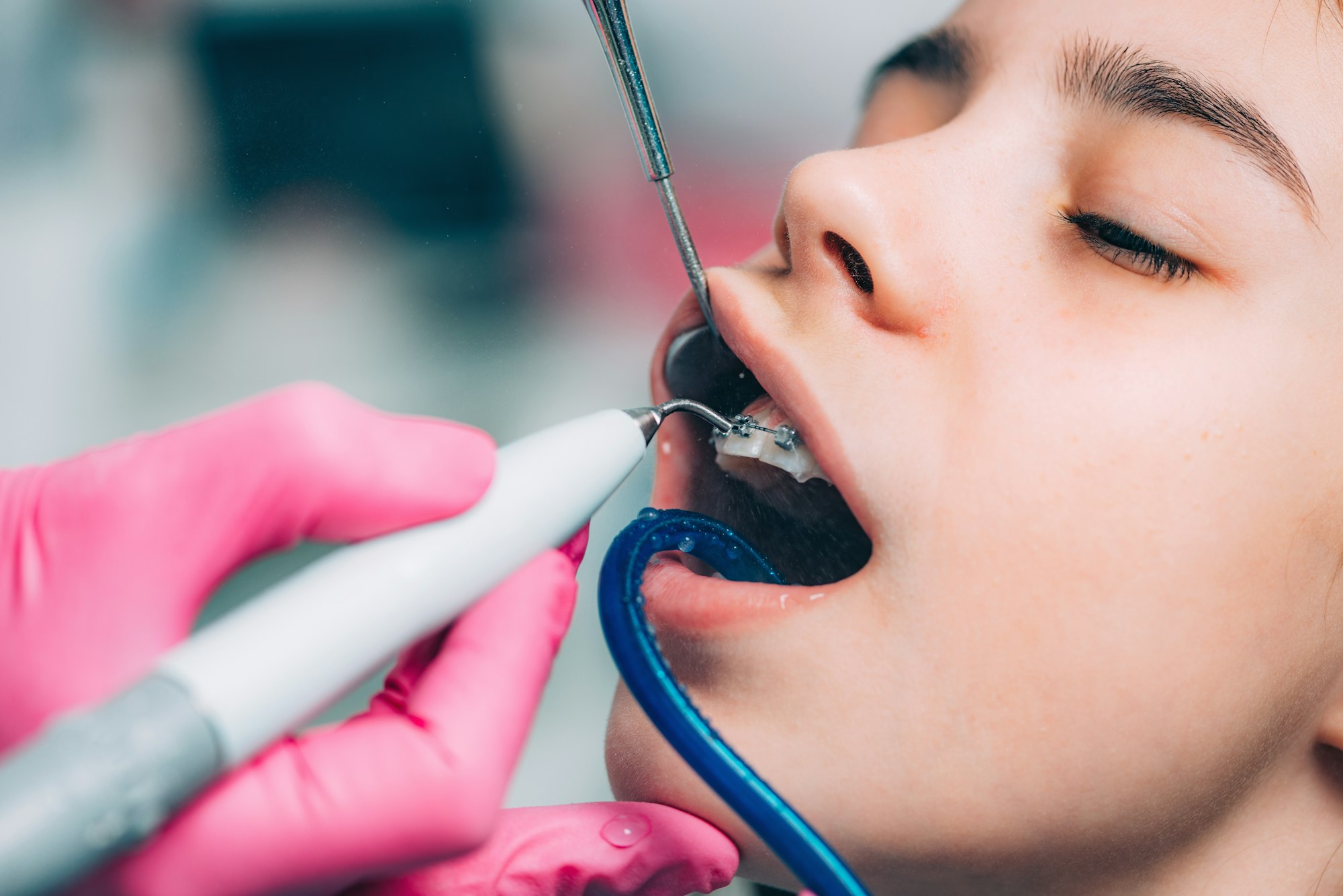 Orthodontist cleaning girl’s teeth with dental braces